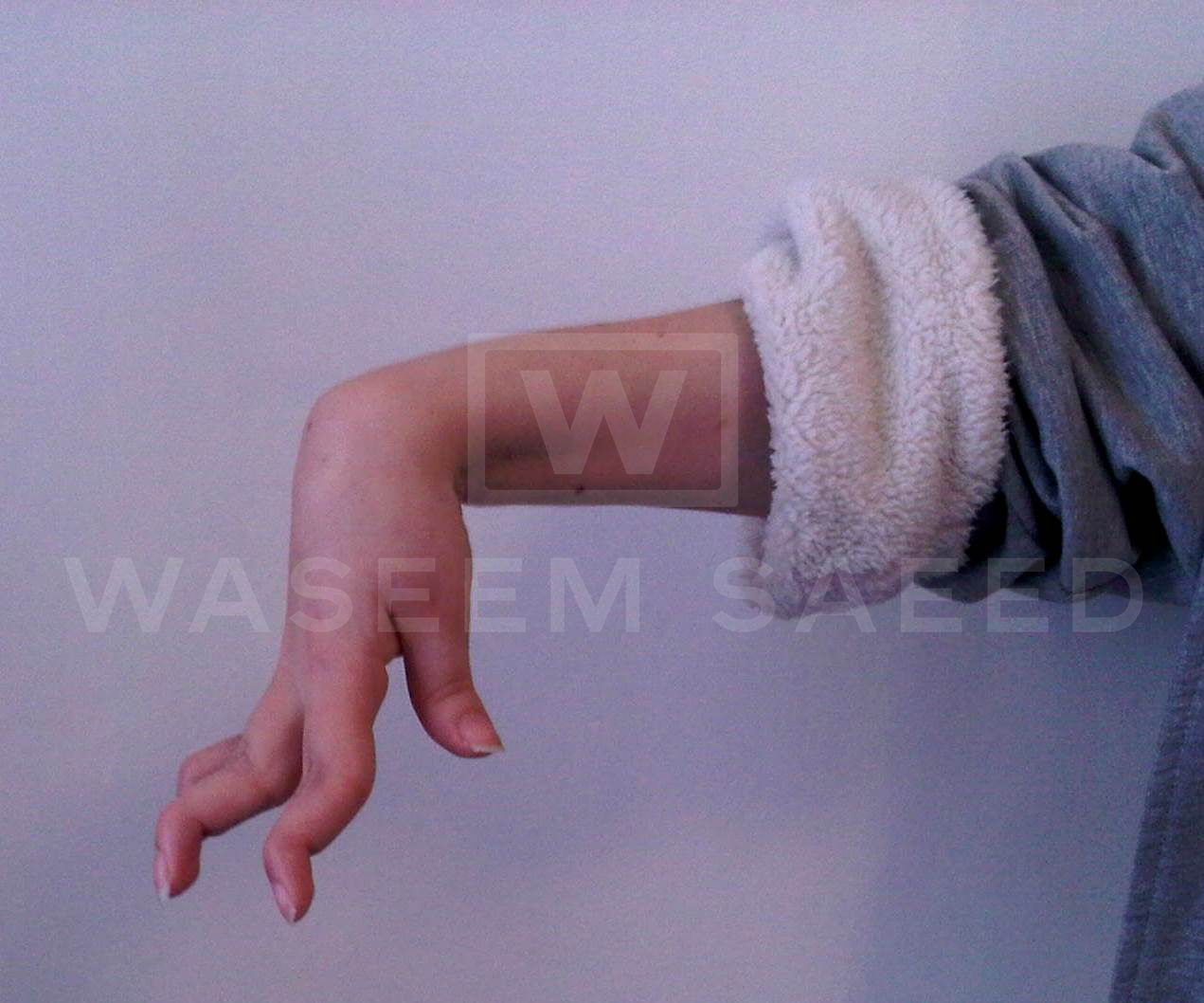 SEVERE TIGHT WRIST, UNABLE TO STRAIGHTEN