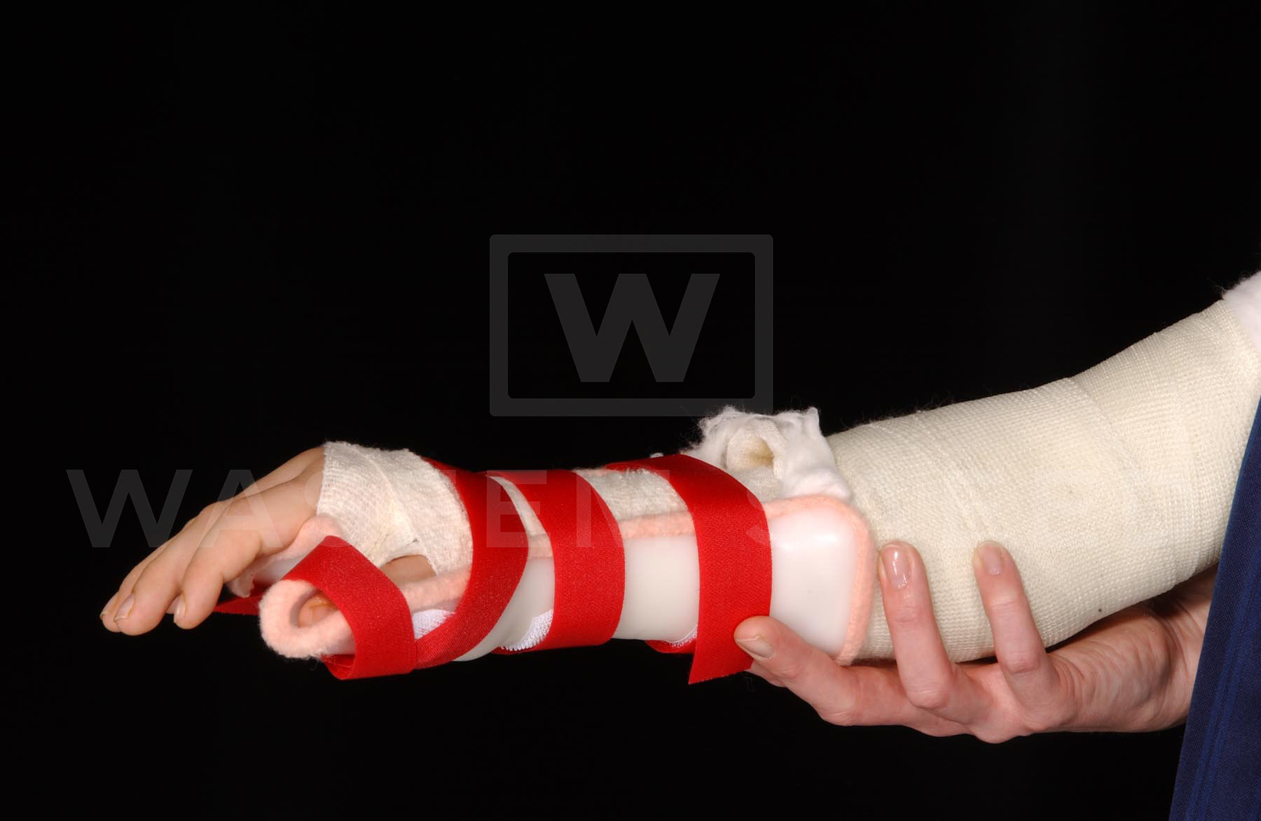 Splint therapy, cerebral palsy